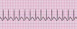 Electrocardiogram (ECG) strip showing rapid, regular heartbeats consistent with supraventricular tachycardia on a red grid background.