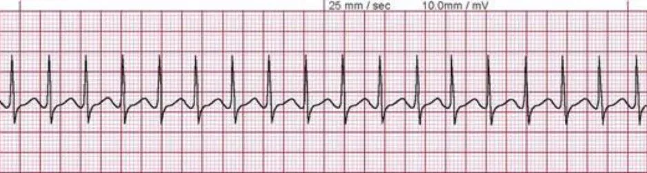 Supraventricular Tachycardia