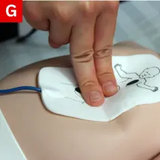 PALS Figure 10 G Resume CPR for two minutes