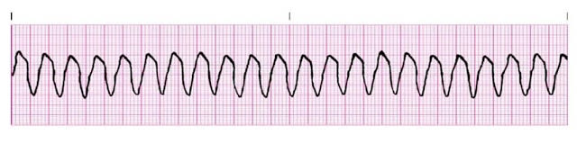 Polymorphic Ventricular Tachycardia