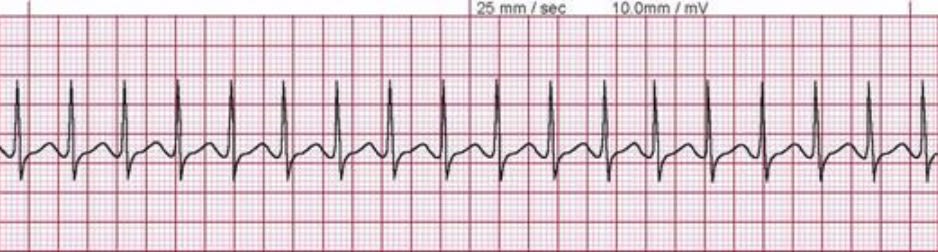 Supraventricular Tachycardia
