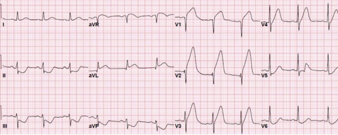 7 anterior stemi