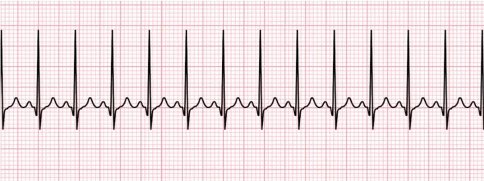 PALS 1 sinus tachycardia