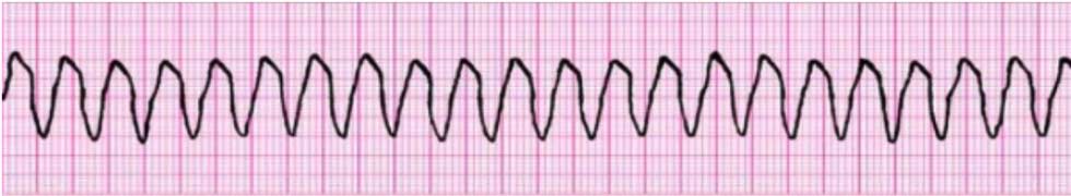 PALS 4 unstable wide complex tachycardia