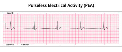 Pulseless Electrical Activity ECG Paper