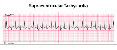 Supraventricular Tachycardia - Electrocardiography Paper