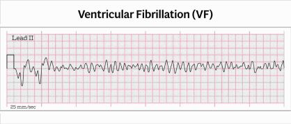 Ventricular Fibrillation Rhythm