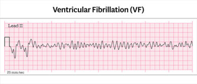 ECG strip showing ventricular fibrillation (VF) with irregular, uncoordinated waveforms and no identifiable QRS complexes on a grid background.