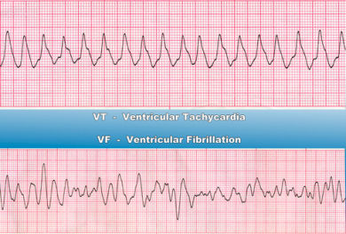 ECG strips showing ventricular tachycardia (VT) on the top and ventricular fibrillation (VF) on the bottom, with labels for each rhythm on a blue background.